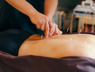 Acupuncture, planned around you 1